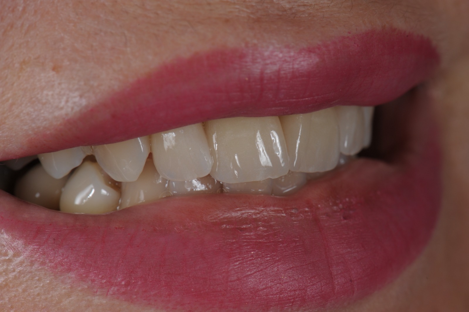 Caso clinico in ceramica feldspatica — 07