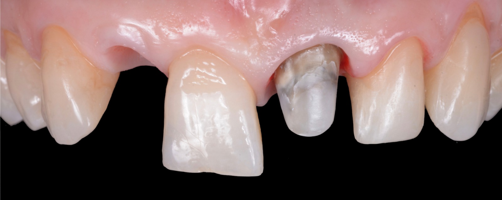 Caso clinico con corone in metallo ceramica — 02