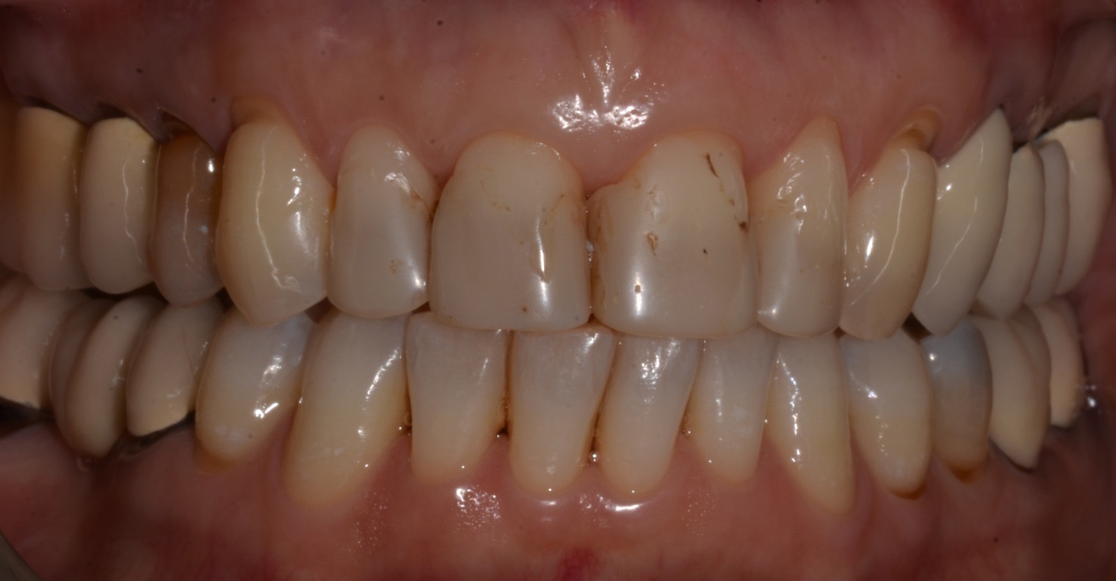 Caso clinico in ceramica feldspatica — 11