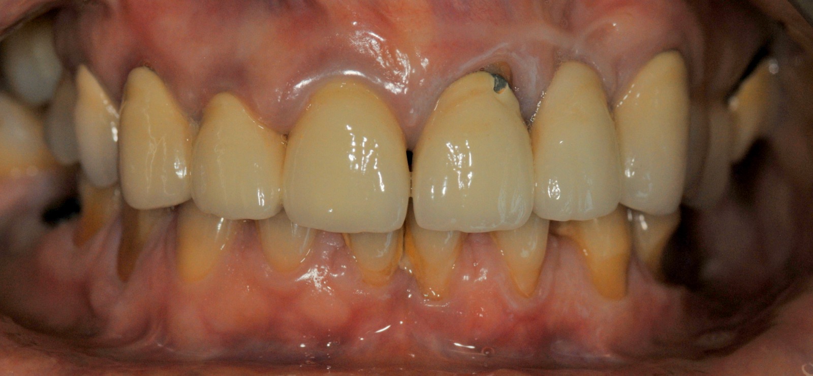 Caso clinico in zirconia — 01
