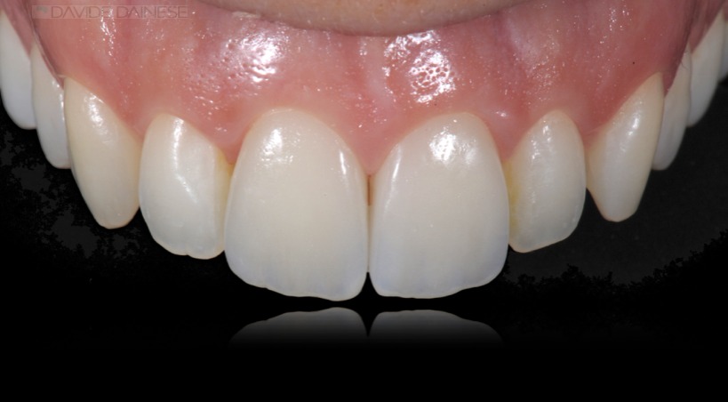 Caso clinico in ceramica feldspatica — 05