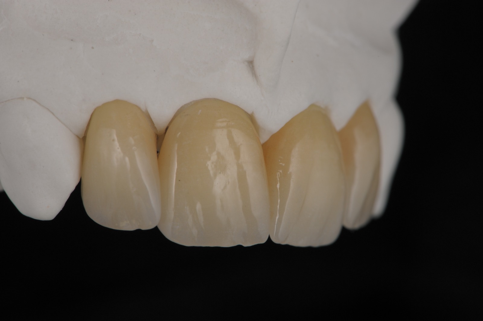 Caso clinico in ceramica feldspatica — 08