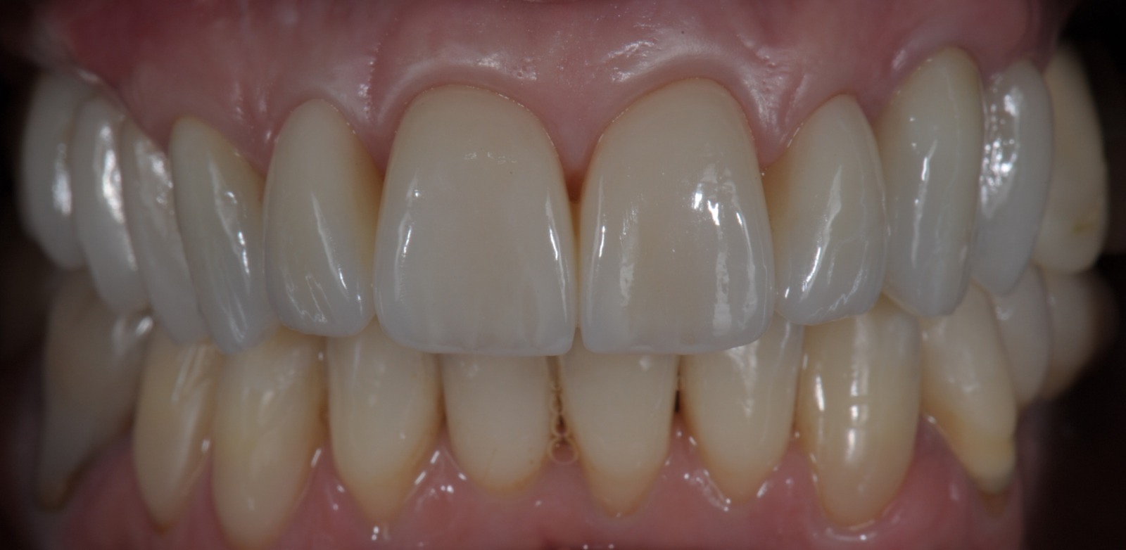 Caso clinico in zirconia — 06