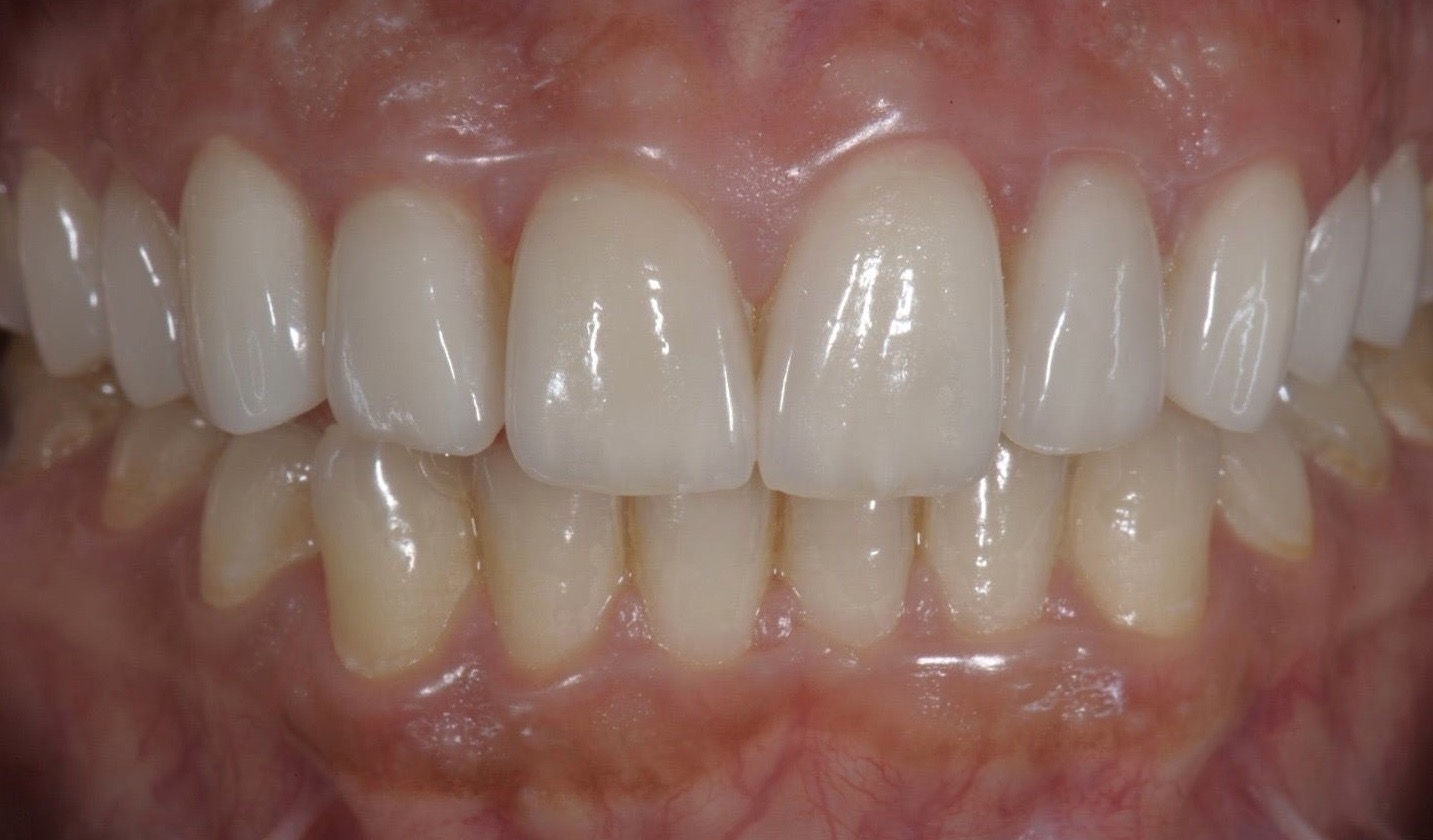 Caso clinico in ceramica feldspatica — 10
