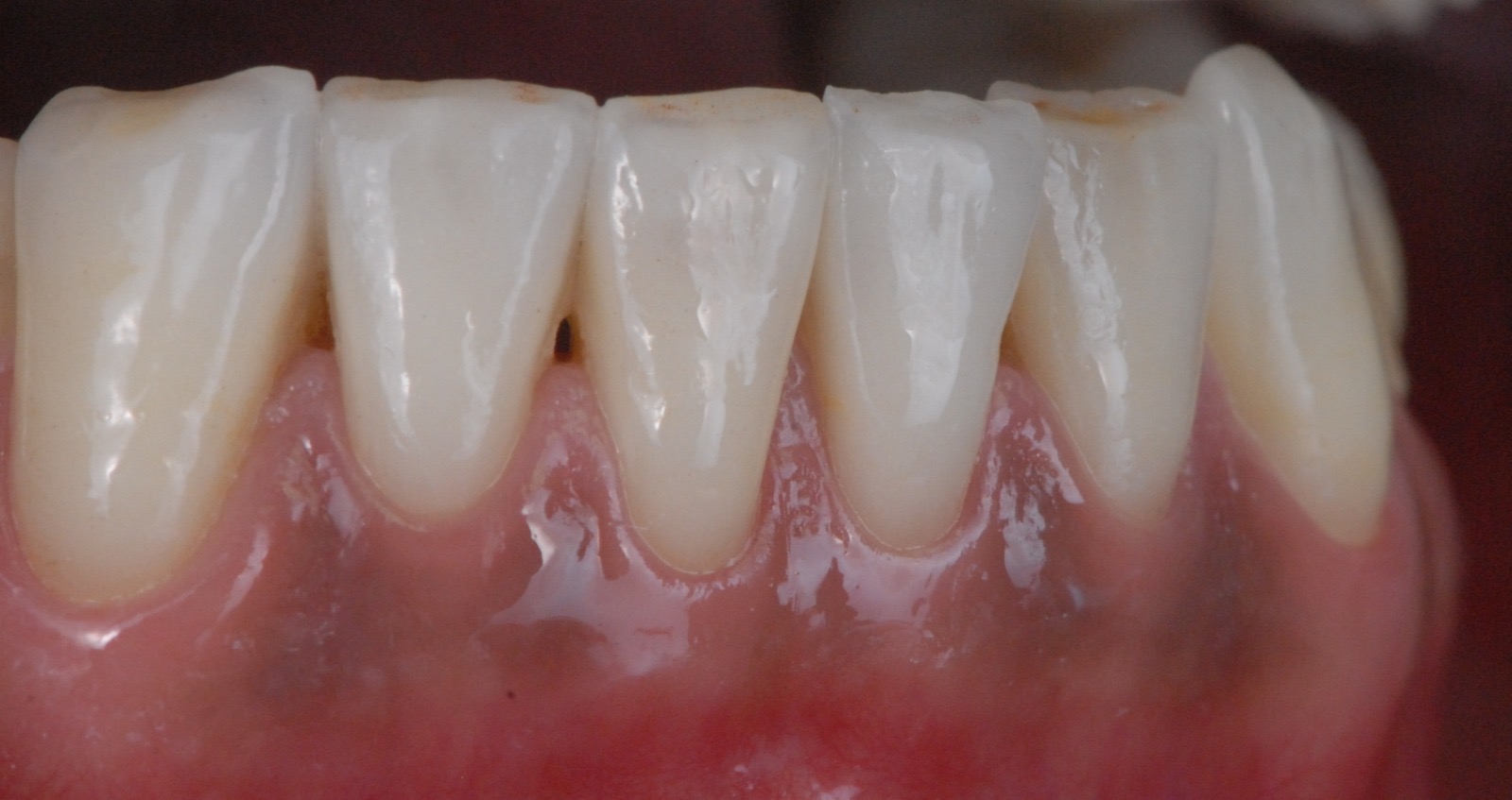 Caso clinico in ceramica feldspatica — 02