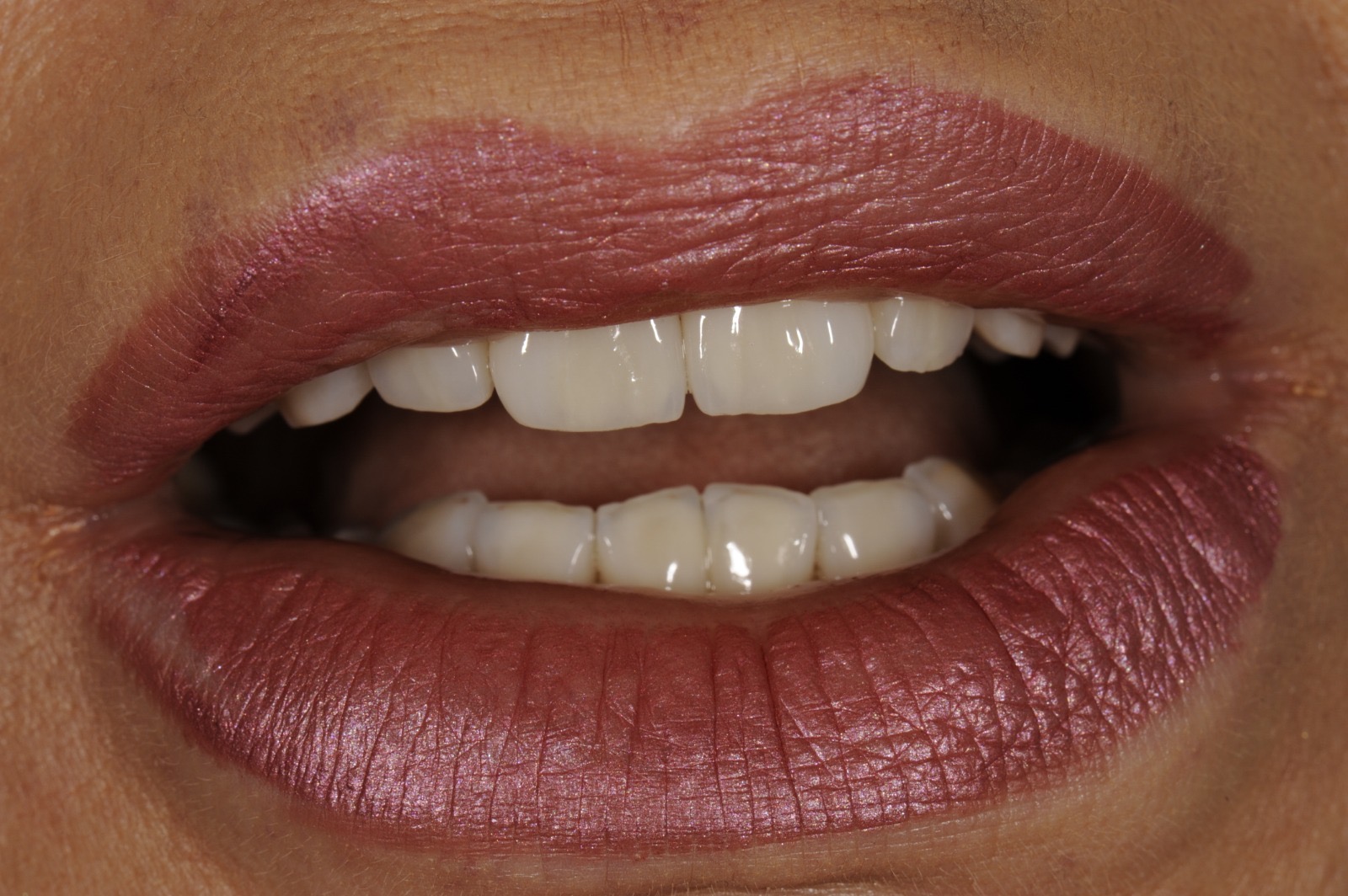 Caso clinico in zirconia — 04