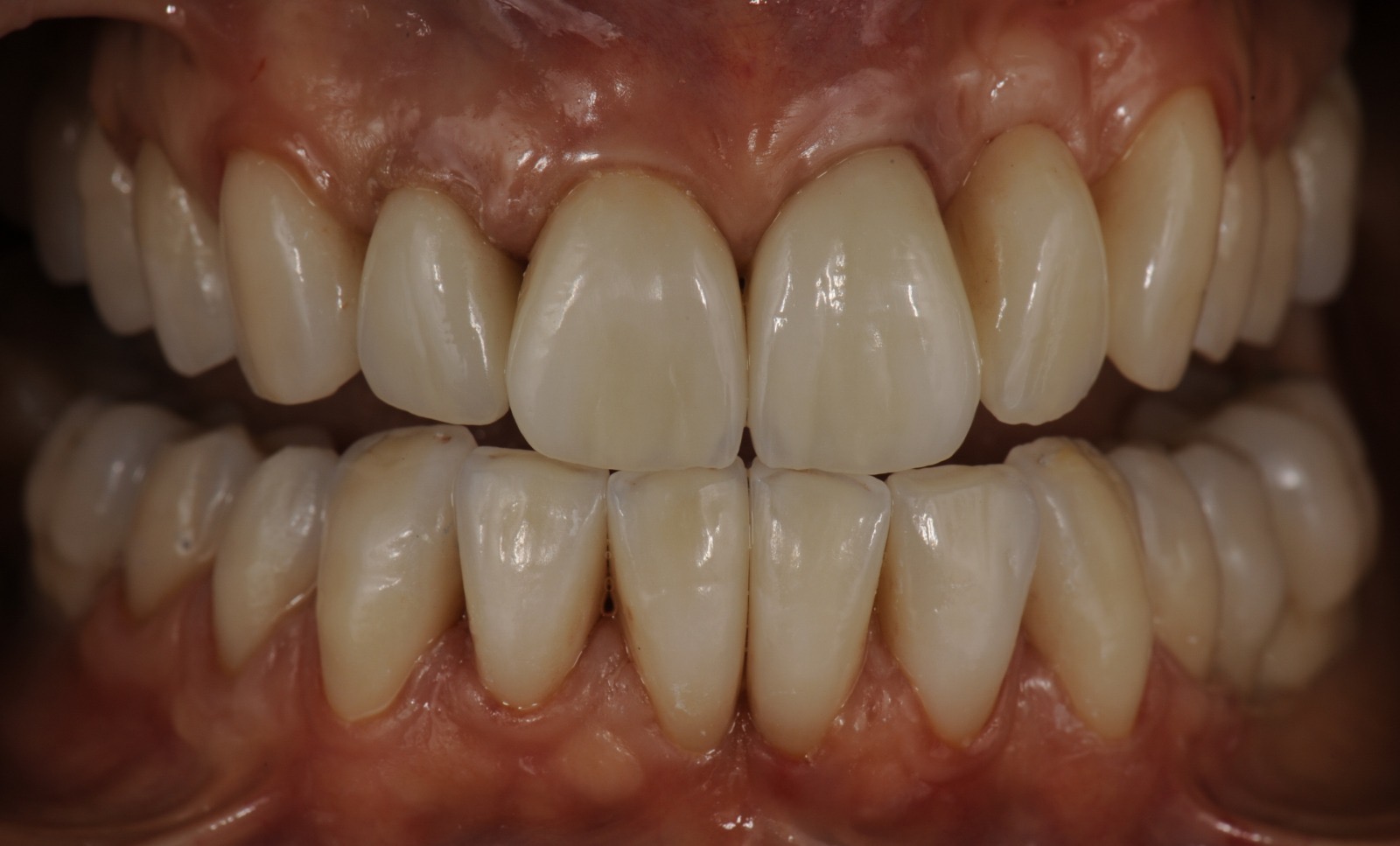 Caso clinico in zirconia — 02