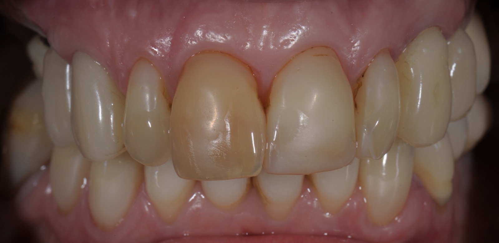 Caso clinico in zirconia — 05