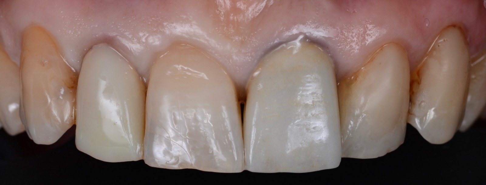 Caso clinico con corone in metallo ceramica — 01