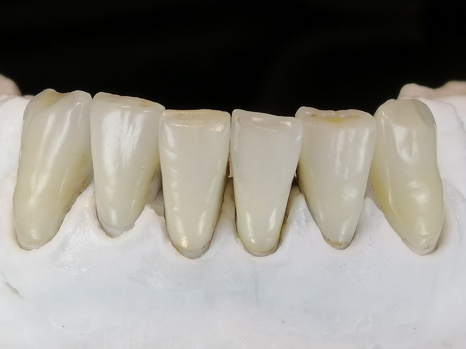 Caso clinico in ceramica feldspatica — 01