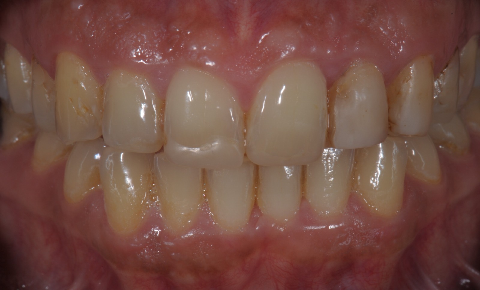 Caso clinico in ceramica feldspatica — 09