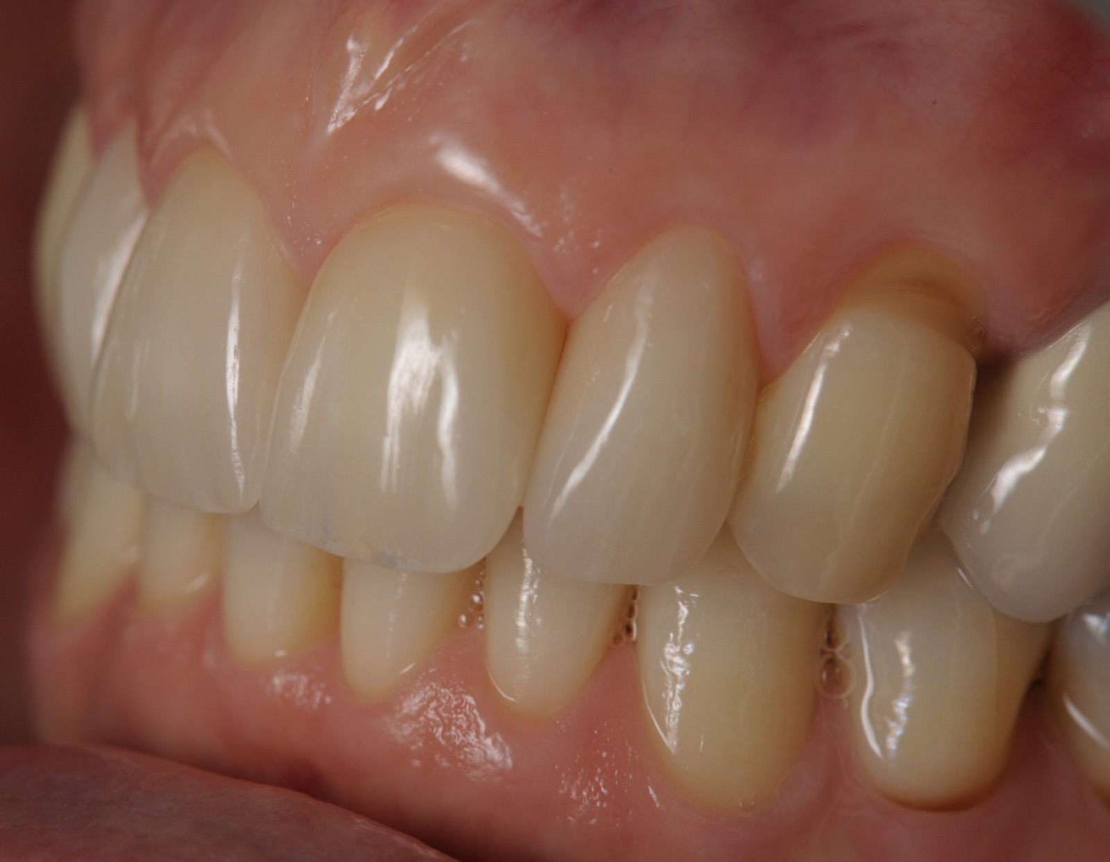Caso clinico in ceramica feldspatica — 13