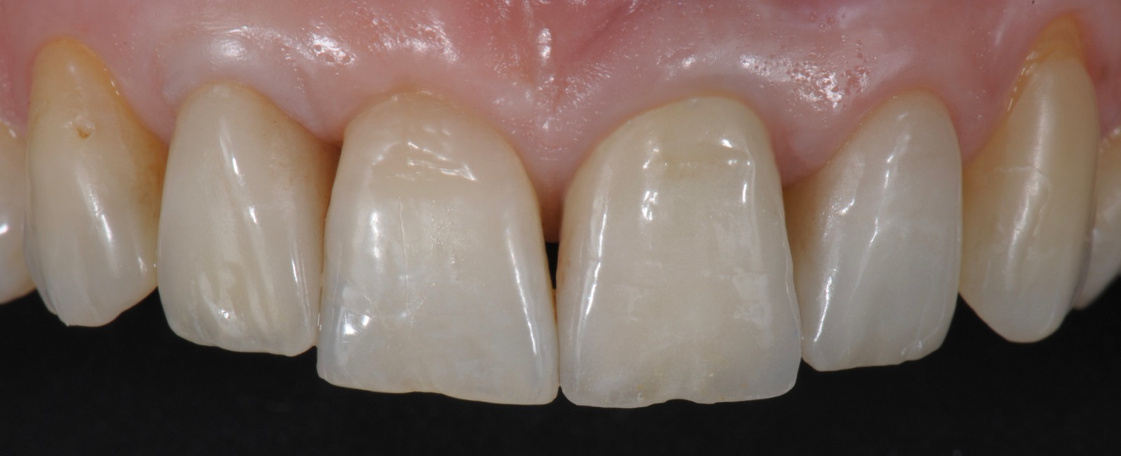Caso clinico con corone in metallo ceramica — 03