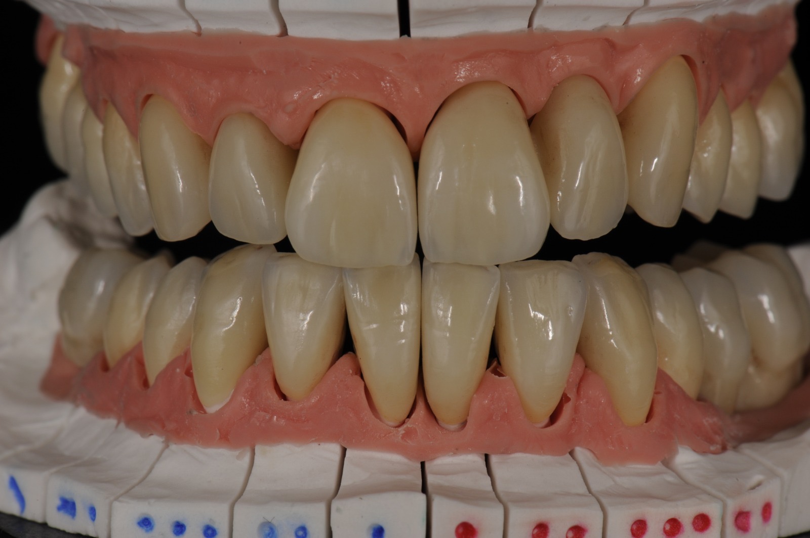 Caso clinico in zirconia — 03