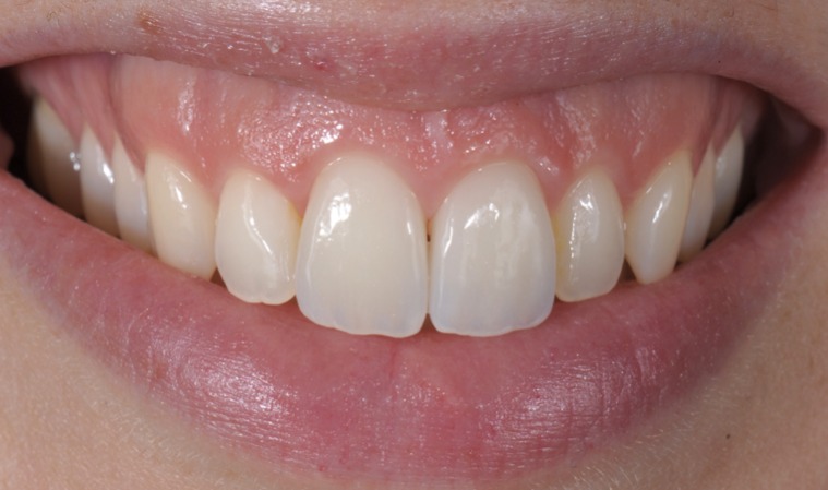 Caso clinico in ceramica feldspatica — 06