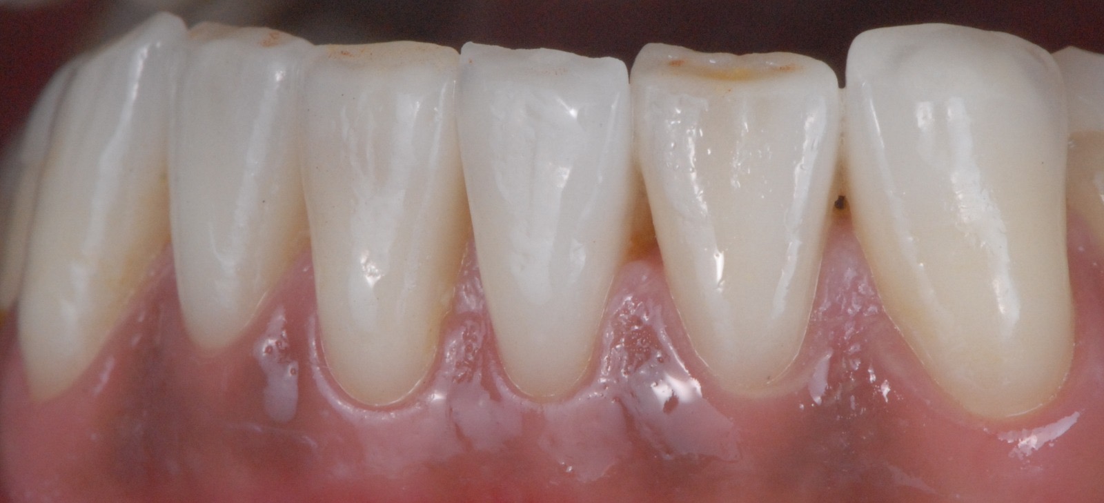 Caso clinico in ceramica feldspatica — 03