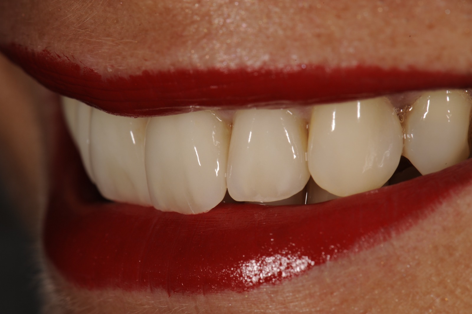 Sorriso con faccette in ceramica