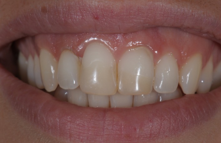Caso clinico in ceramica feldspatica — 04