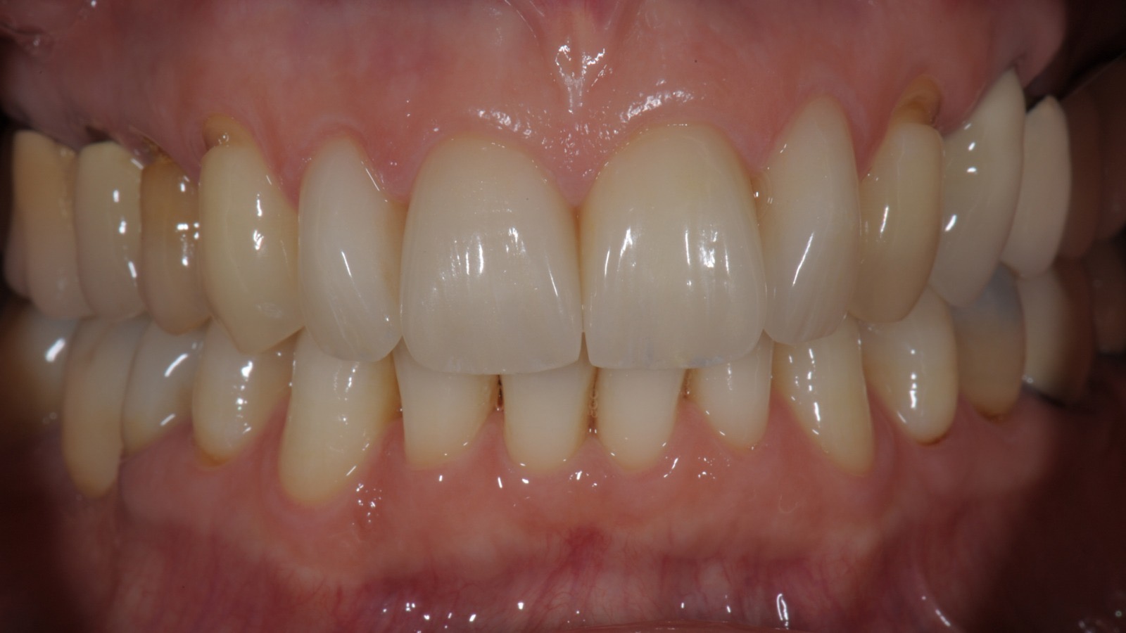 Caso clinico in ceramica feldspatica — 12